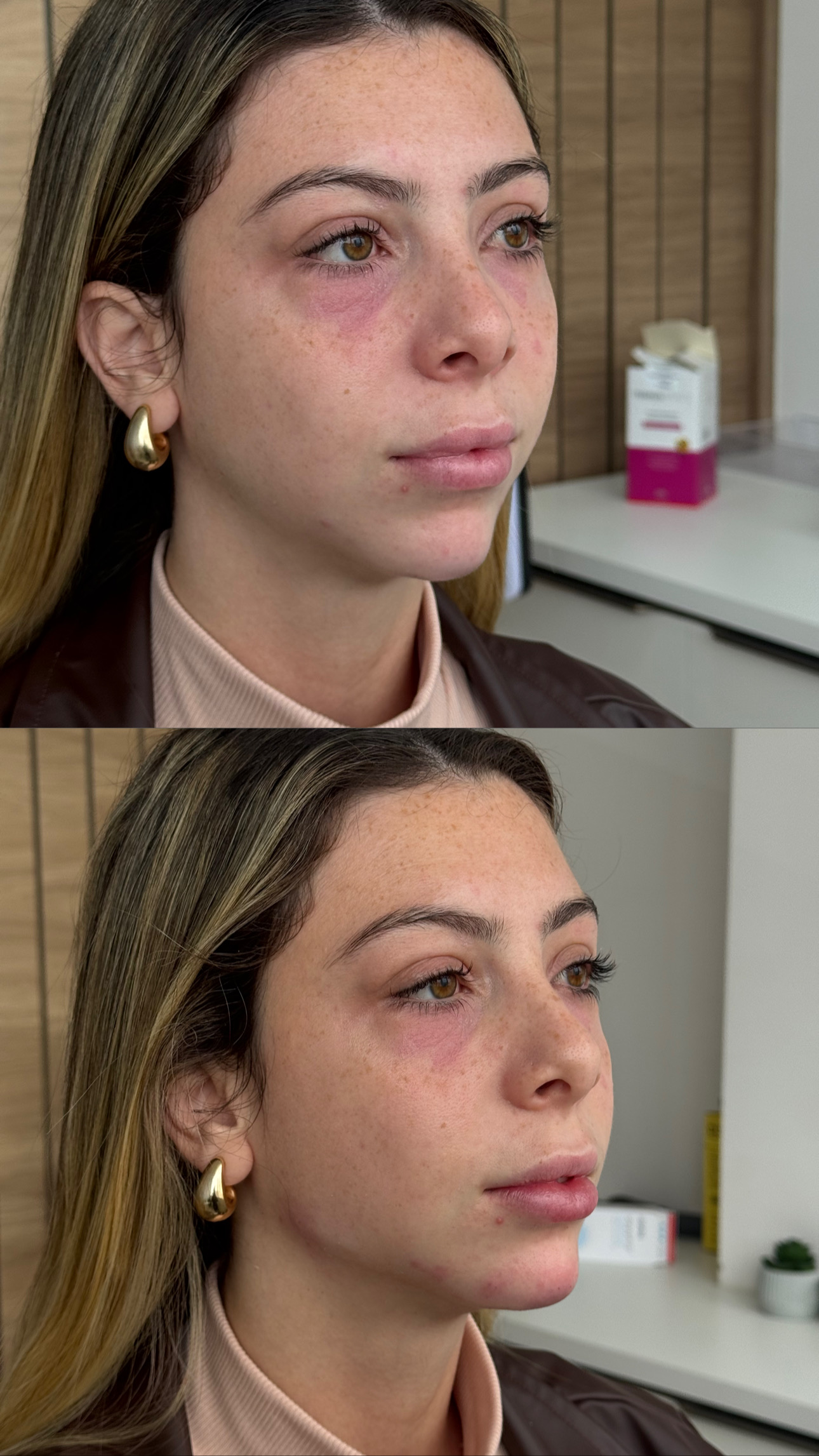 Resultado — Botox